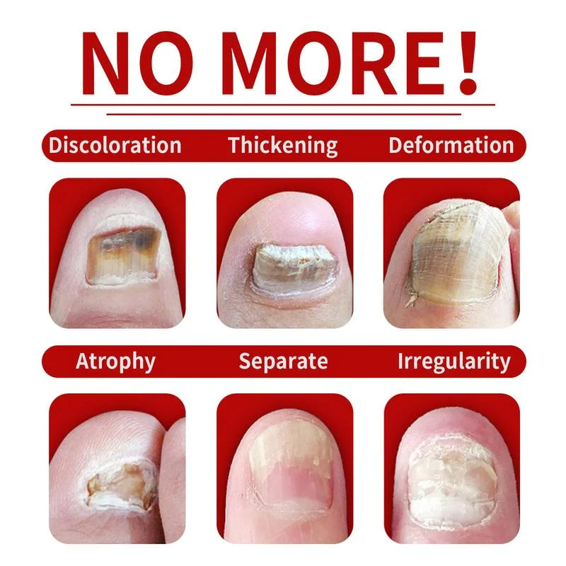FungaRelief™ | Natural Fungus Removal in 7 Days!