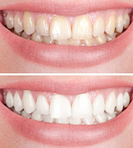BrightGlow™ | Revolutionary Advanced Teeth Whitening