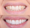 BrightGlow™ | Revolutionary Advanced Teeth Whitening