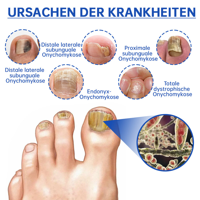 NailEssence™ | Fungus Laser Therapy Device