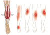 KneeRelief™ | Fast Relief Your Knees Deserve!