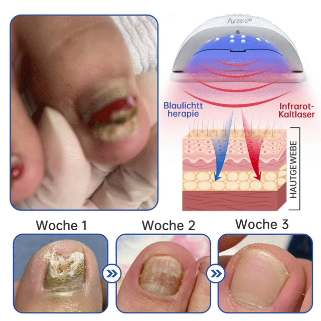 NailEssence™ | Fungus Laser Therapy Device