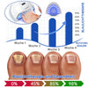 NailEssence™ | Fungus Laser Therapy Device