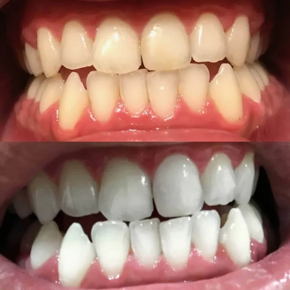 DiamondSmile™ | Radiant Smile in Just 10 Minutes!