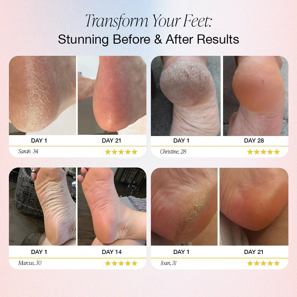 CalluXpert™ | Electric Foot Callus Remover