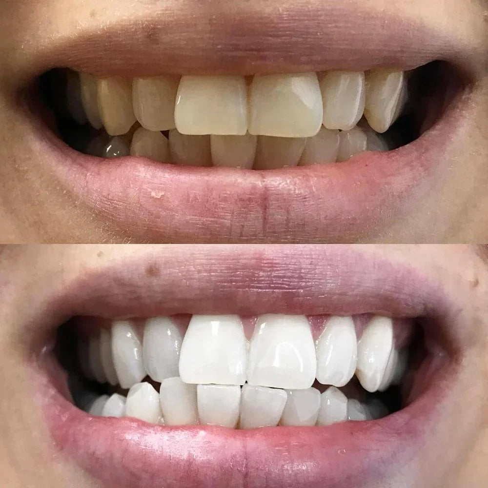 DiamondSmile™ | Radiant Smile in Just 10 Minutes!