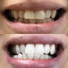 DiamondSmile™ | Radiant Smile in Just 10 Minutes!