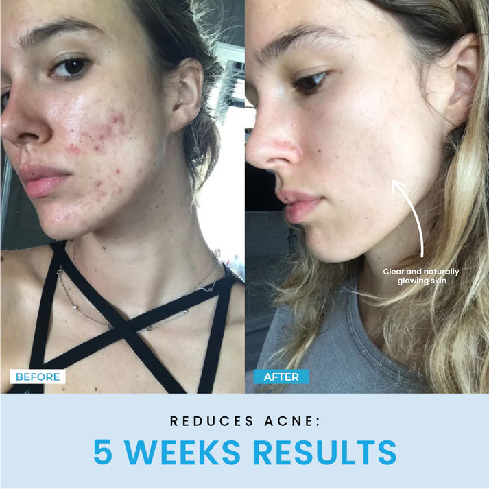 V-Sculpt™ | Redefine Your Jawline in Just 5 Minutes a Day!
