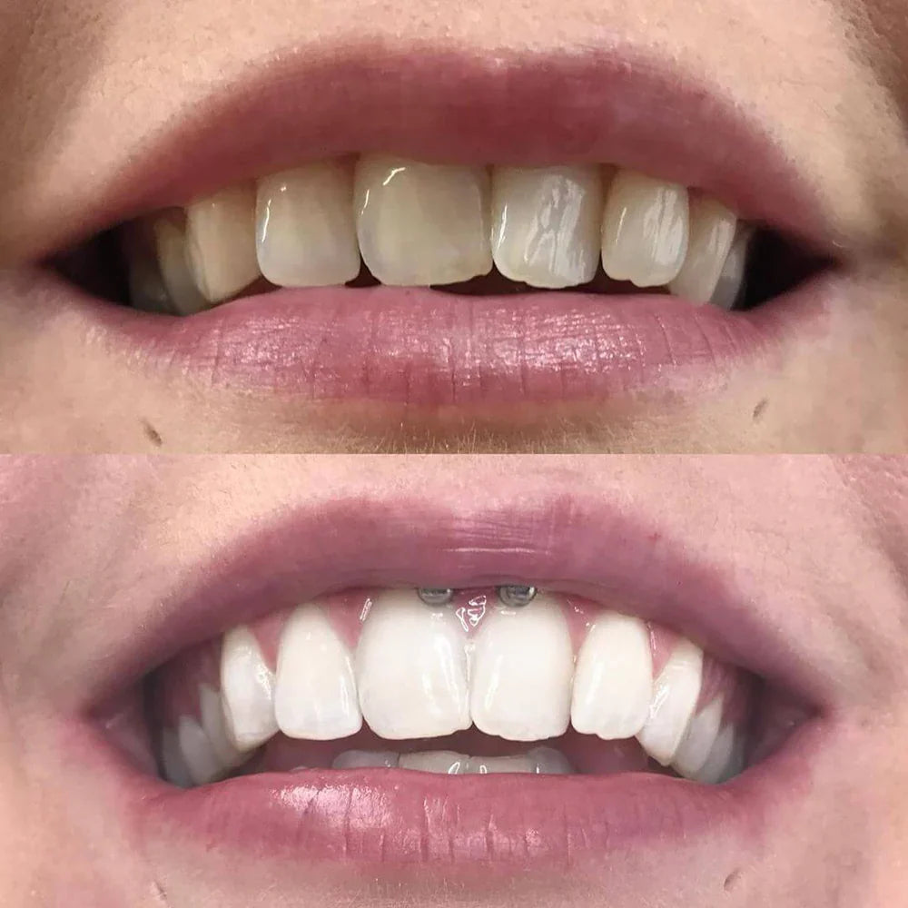 DiamondSmile™ | Radiant Smile in Just 10 Minutes!