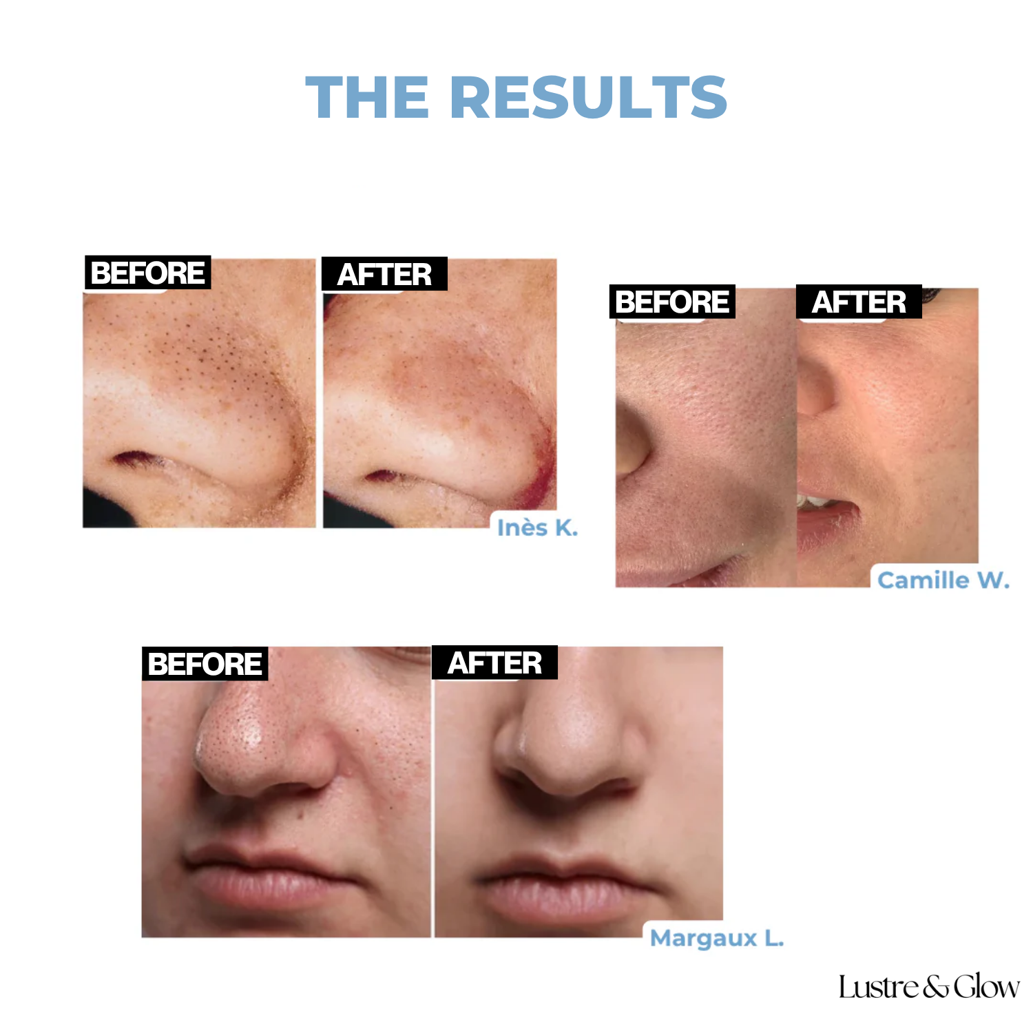 SkinRefine™ | Serum That Targets Clogged Pores For Flawless Skin