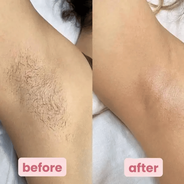 PureSmooth™ | Experience Pain-Free, Bump-Free Hair Removal