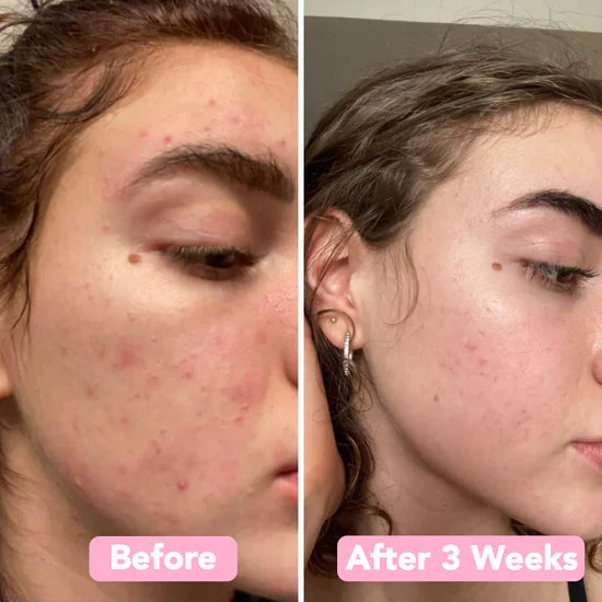 SpotLessGlow™ | For Smoother, Clearer, and Brighter Skin — Every Day!