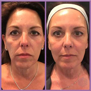 Azure Microcurrent Facial Toner (Last Day Sale!)