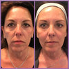 Azure Microcurrent Facial Toner (Last Day Sale!)