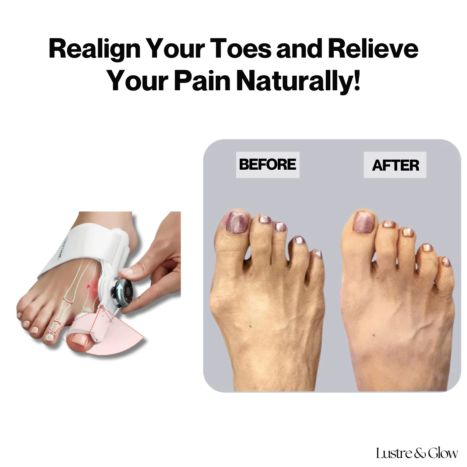 ToeRelief™ | Pain-Free Toe Correction In Minutes A Day!