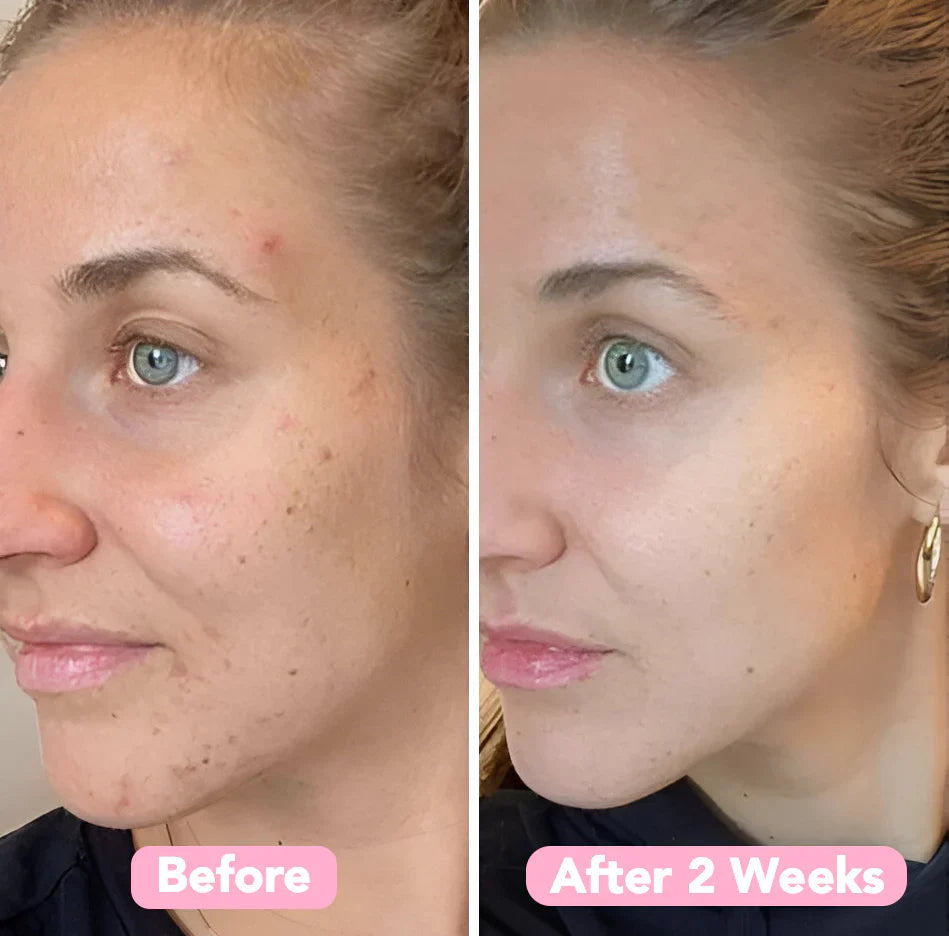 SpotLessGlow™ | For Smoother, Clearer, and Brighter Skin — Every Day!