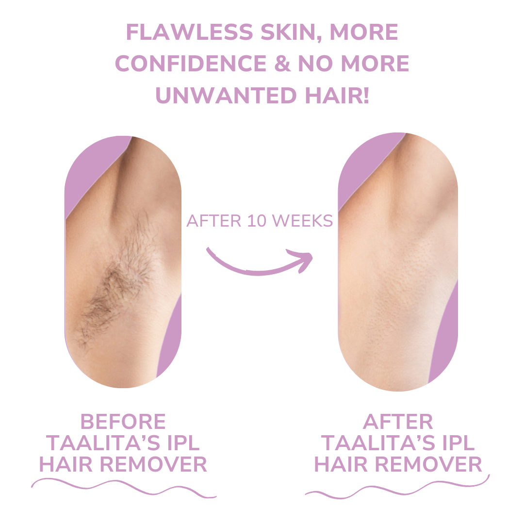 LumaGlow™ | The Ultimate At-Home Laser Hair Removal Solution