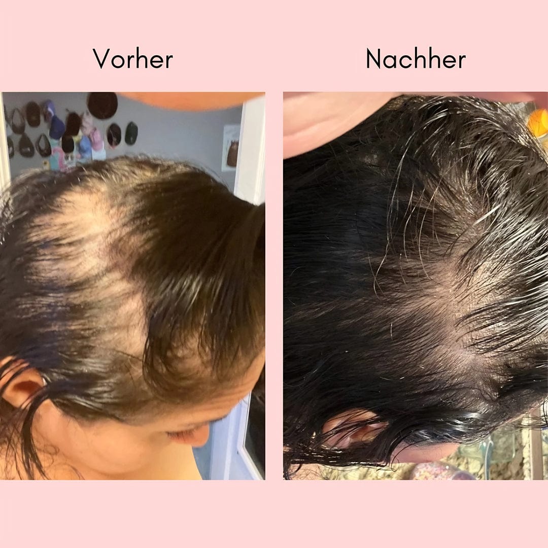 Rootéva™ | Nature’s Answer to Thinning Hair!