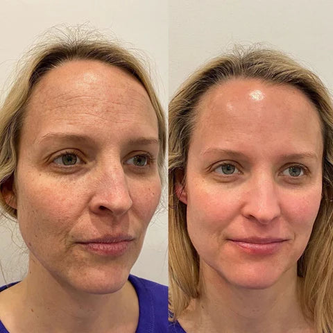 SkinSuction™ | Your Skin’s Best Friend Against Blackheads