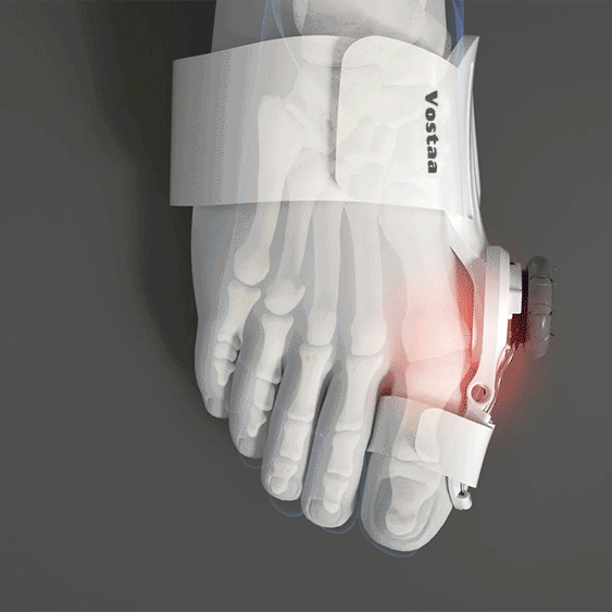 ToeRelief™ | Correct Your Bunion, Step by Step!