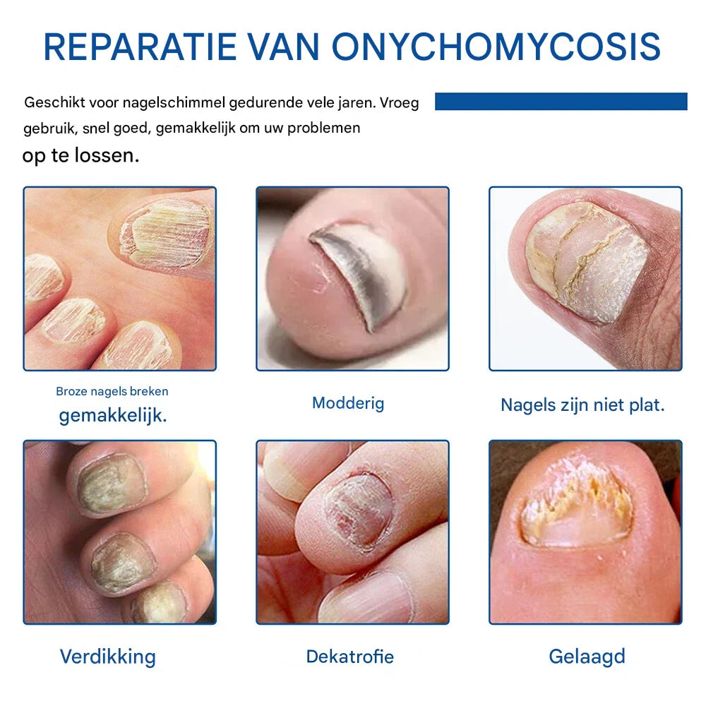 NailRenew™ | Protect And Restore Your Nails From Fungus